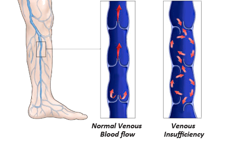 What is Venous Insufficiency